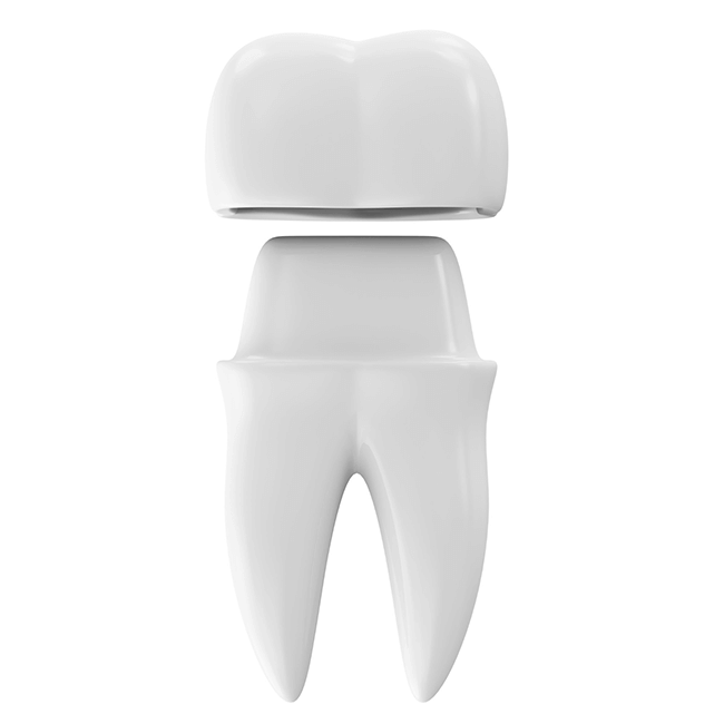 prednosti dentalnih krunica